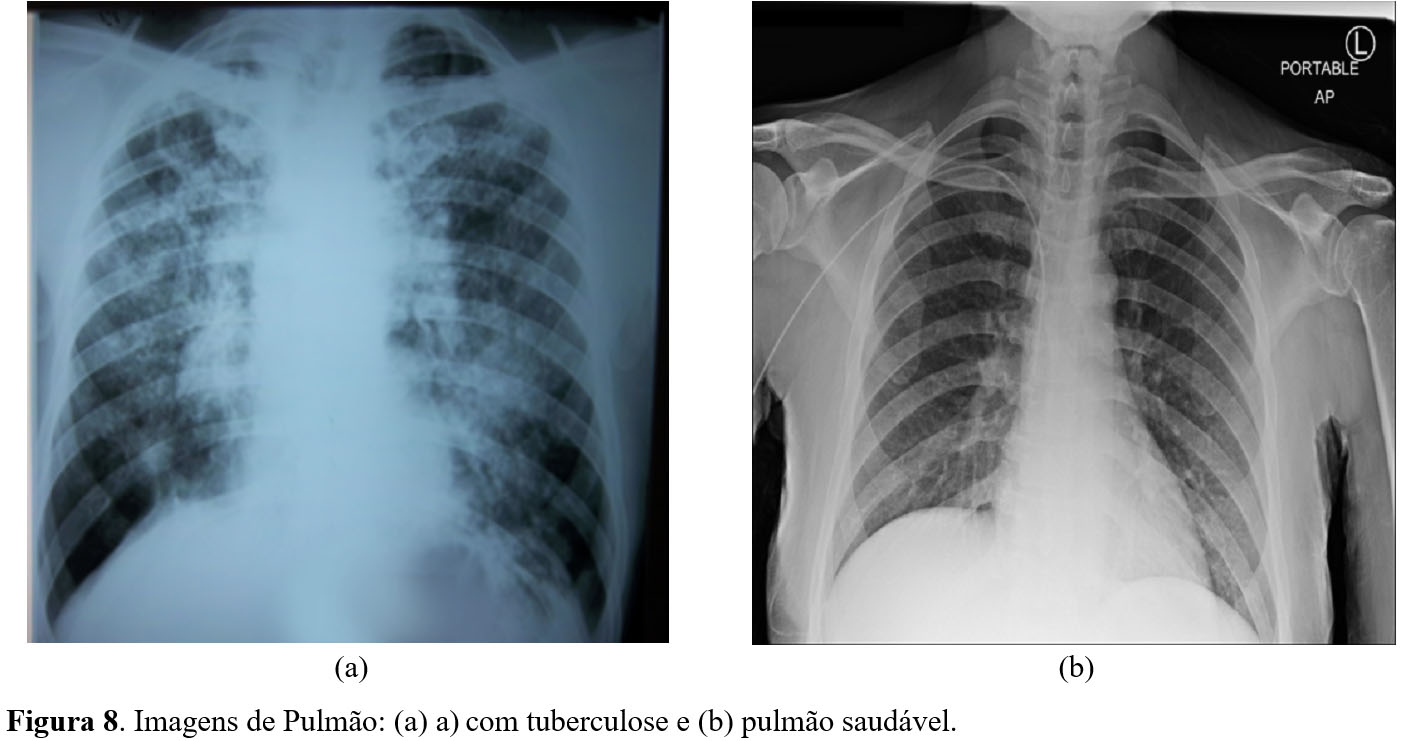Para a realização de testes, fora utilizadas imagens de pulmão com tuberculose e pulmão saudável, respectivamente, conforme mostradas na Figura 8.